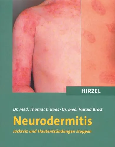 Neurodermitis. Juckreiz und Hautentzündungen stoppen